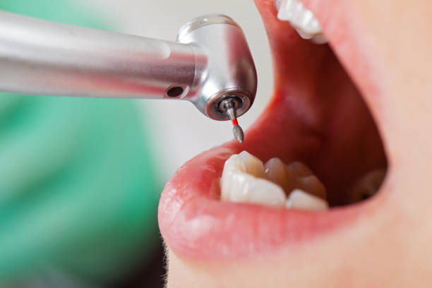 Best Broken or Cracked Tooth Emergency Dentist in Lake Mary Jane, FL